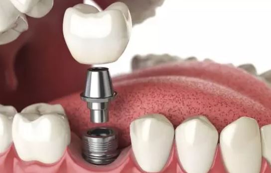 درباره ایمپلنت دندان برای جایگزین بی دندانی بیشتر بدانید